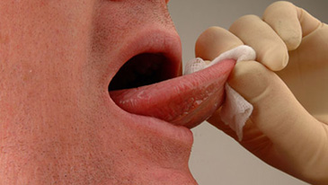 Mouth Cancer